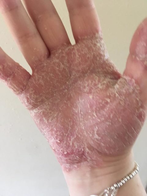 Case Study-Psoriasis